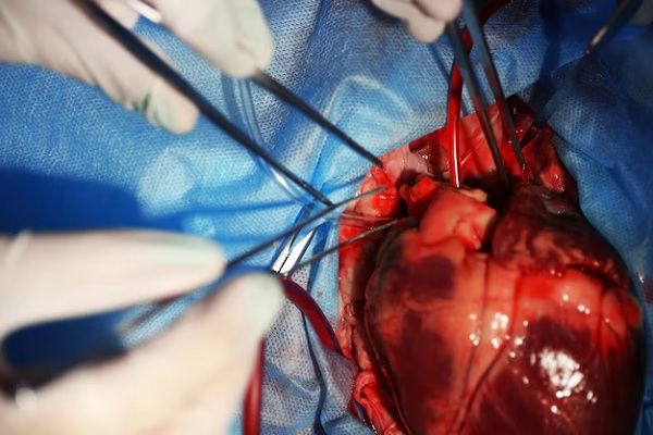 trasplante de corazón - imagen de una operación de trasplante de corazón