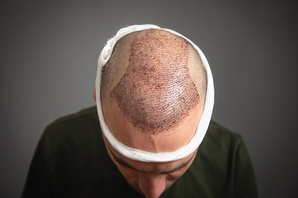 Injerto de cabello - hombre mostrando un implante capilar días después de la cirugía 