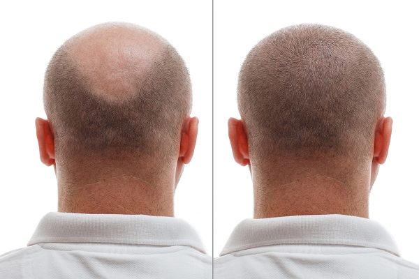 imagen del antes y después de un trasplante capilar