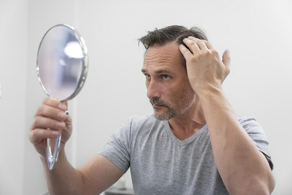 injerto de cabello - hombre revisando en el espejo el retroceso de la línea del cabello