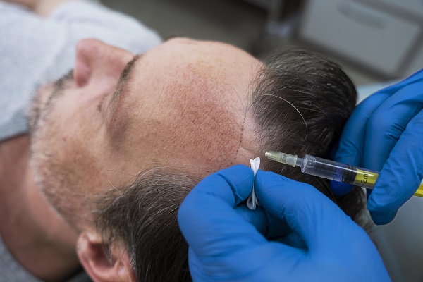 injerto de cabello - especialista aplicando un tratamiento capilar en inyecciones