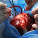 Trasplante de corazón - imagen de una cirugía a corazón abierto