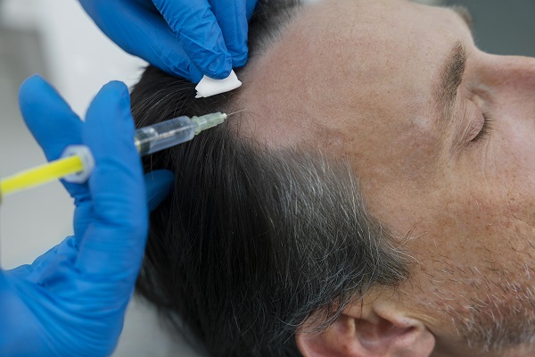 Cuánto cuesta un injerto de cabello en CDMX en 2025: precios, técnicas y cómo elegir la mejor clínica