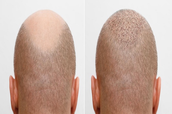 hombre con alopecia, mostrando el antes y después de la cirugía de trasplante de cabello