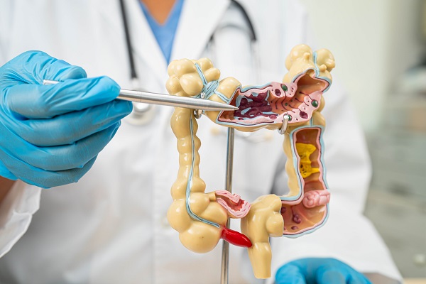 Cáncer de colon - especialista explica cómo comienza y sus causas principales 