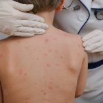 Historia natural del sarampión, un medico trata a niño con esta enfermedad