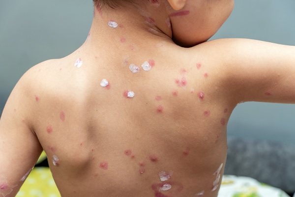 espalda de niño con sarampión siendo tratada con cremas