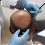 Trasplante capilar - hombre al que le marcan la zona posterior de la cabeza donde va a realizarse su implante de cabello