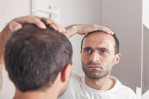 Trasplante capilar - hombre con pronunciada calvicie, debe considerar el trasplante de cabello con opción 
