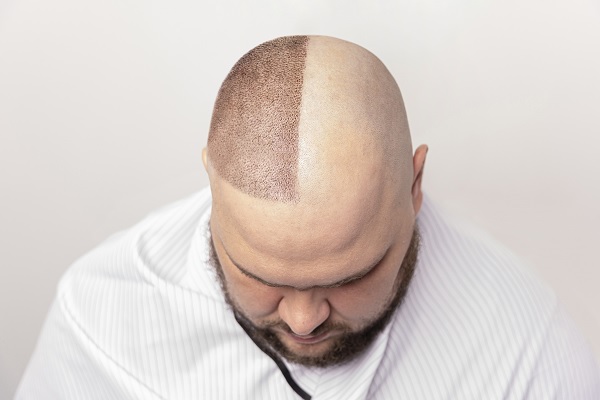 hombre mostrando los resultados de una restauración de pelo, solo en la mitad de su cabello