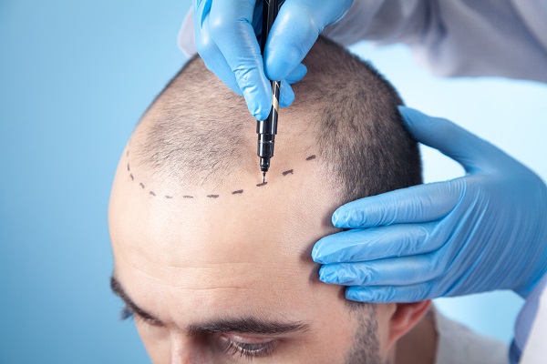 hombre le marcan la línea del cabello para un injerto de cabello