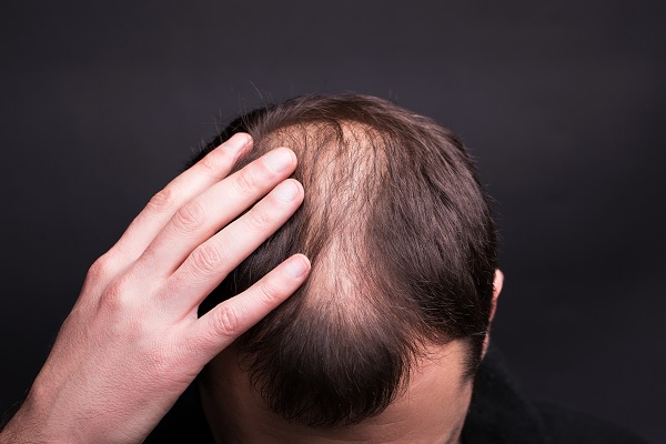 hombre con pronunciada calvicie, listo para el procedimiento de restauración de cabello