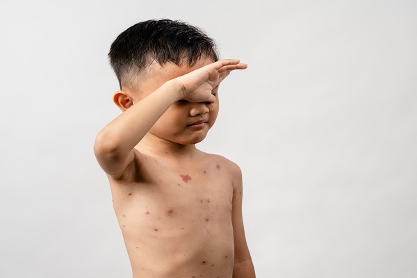 Varicela, niño con erupciones en la piel, signo de esta enfermedad