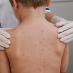 Varicela - un medico examina a niño con sintomas claros de esta enfermedad, como lo es sarpullido en la piel