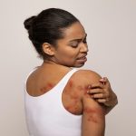 amebiasis cutánea - mujer con ulceras rejas en la espalda, posiblemente por esta enfermedad