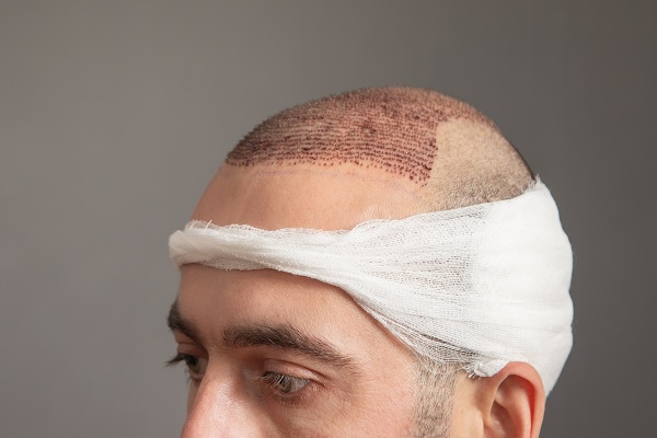implante cabello, hombre mostrando resultados del implante capilar después de acabar de hacerse el procedimiento