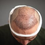 implante cabello - hombre mostrando los resultados inmediatos de su procedimiento que recientemente se hizo