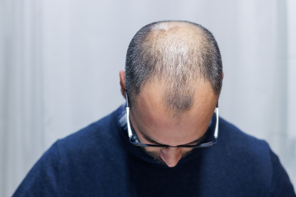 implante cabello, hombre adulto, con evidente alopecia, candidato ideal para un procedimiento de injerto capilar