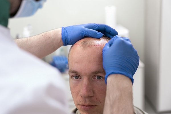 implante cabello, especialista marca la línea de cabello, como inicio del procedimiento de implante capilar