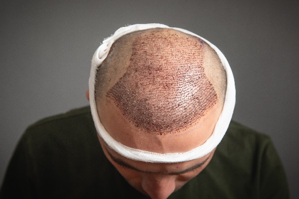 Implante cabello: guía completa para recuperar tu cabello en México
