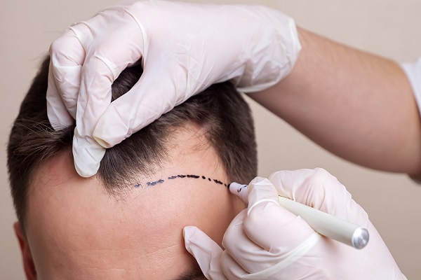 técnicas de injerto capilar - especialista le marca la zona de las entradas del cabello a un paciente con calvicie