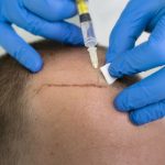técnicas de injerto capilar - hombre con calvicie recibiendo un injerto de cabello