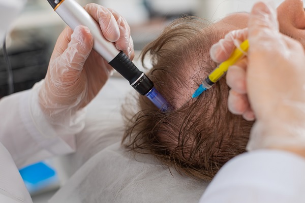 técnicas de injerto capilar - hombre con alopecia, recibiendo un trasplante cabello
