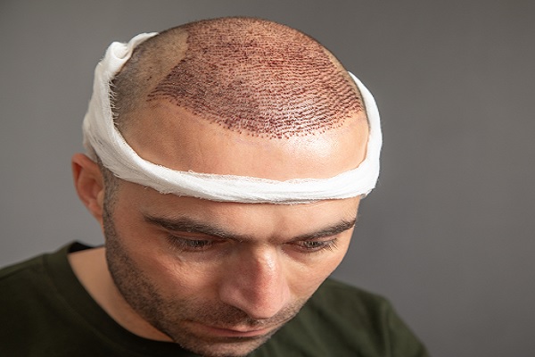 hombre después realizarse un injerto de cabello