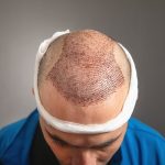 Postoperatorio implante capilar, hombre muestra la cabeza donde recientemente se hizo un implante de cabello