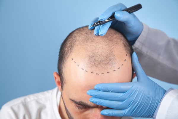 un especialista le marca la zona de las entradas del cabello a hombre , para su proceso de injerto capilar