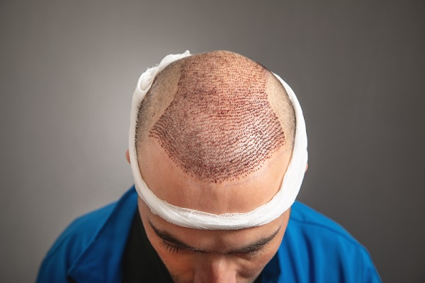Postoperatorio implante capilar, cómo optimizarlo