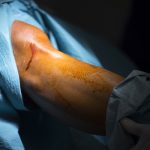 artroscopia, una rodilla de una paciente lista para ser intervenida en cirugía