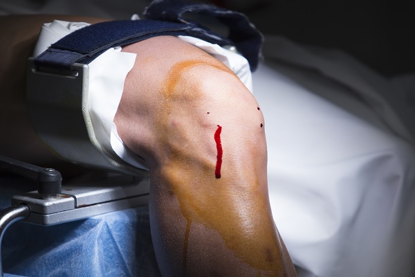 artroscopia, la rodilla de un paciente con pequeñas incisiones para examinar el estado de la rodilla