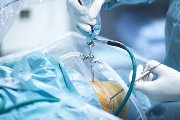 artroscopia, un especialista realiza el procedimiento en la rodilla de un paciente