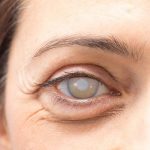 cataratas en los ojos, una mujer con ojos blancos por causa de cataratas avanzadas