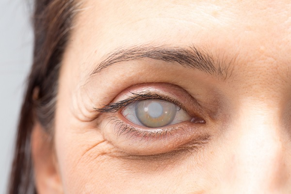Cataratas en los ojos: causas, síntomas y tratamiento efectivo