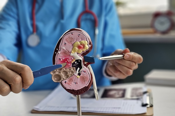 enfermedad renal crónica en México, un medico especialista explica las enfermedades de los riñones, usando un riñón de plástico como referencia