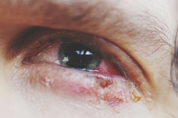 conjuntivitis bacteriana, primer plano de ojo enrojecido