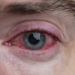 conjuntivitis bacteriana, ojo de una persona con esta enfermedad bacteriana