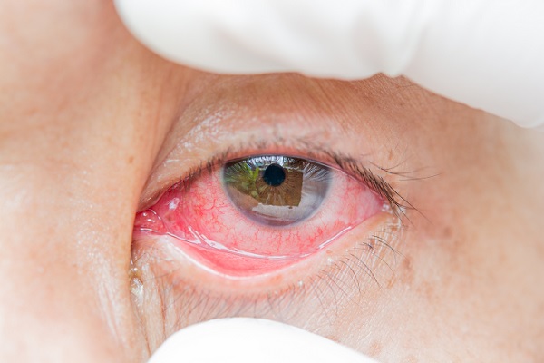 conjuntivitis bacteriana, especialista con guantes le abre el ojo a paciente