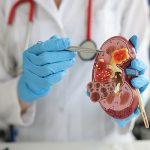 glomerulonefritis, especialista sostiene y señala un riñón hecho de plástico