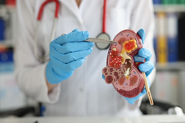 Glomerulonefritis: todo lo que debes saber si te han diagnosticado