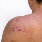 mpox - persona con erupciones cutáneas en la espalda