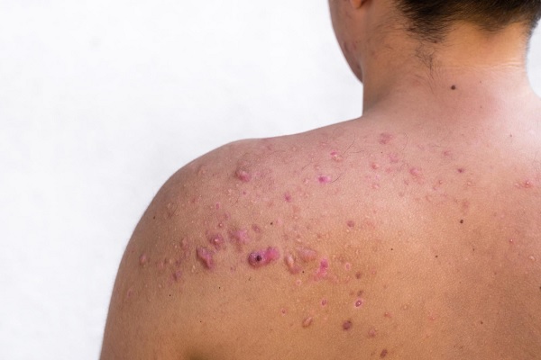 Mpox en México: síntomas, contagio, tratamiento y prevención