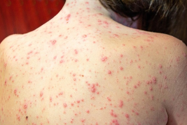 mpox - una mujer de espaldas con erupciones cutaneas
