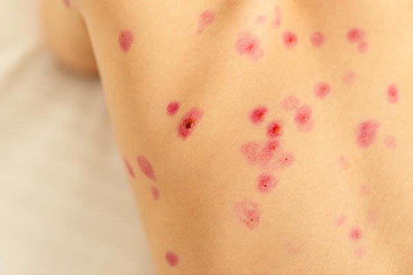 mpox - vista de erupciones cutáneas en la espalda de un niño