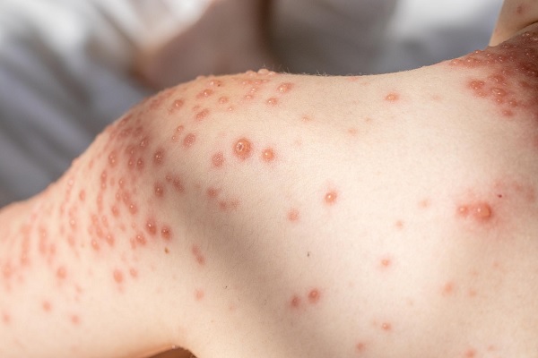 mpox - parte del brazo con muchas erupciones cutaneas