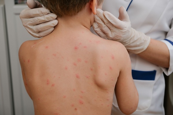mpox - un medico examina a niño con erupciones cutáneas