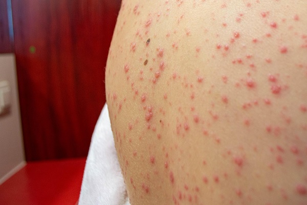 la espalda de un niño con muchas erupciones cutáneas
