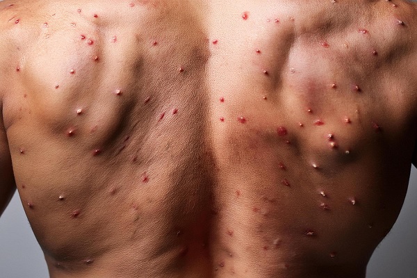 mpox - la espalda de un hombre con erupciones